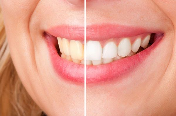 Teeth Whitening | Dentist Deer Park