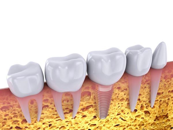 Dental Implants A Smart Choice for your Smile