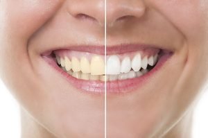 How to Get Rid of Yellow Teeth in One Day