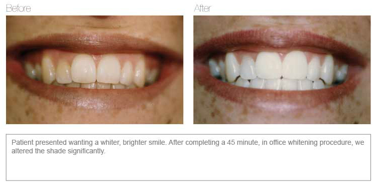 teeth whitening aspendale